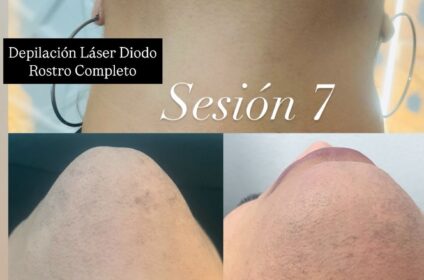 ✨Depilación Láser Diodo Rostro Completo✨