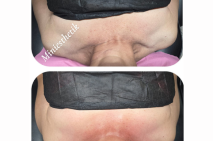 Resultados reales de tratamiento reafirmante para cuello en Ponce.