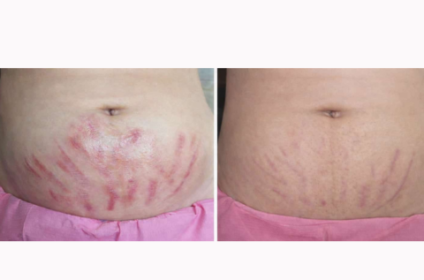 Antes y después de tratamiento para eliminación de estrías en Mini Esthetik Ponce.