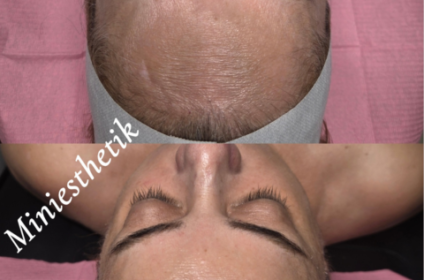 Tratamiento facial antiedad avanzado para rejuvenecimiento en Mini Esthetik, Ponce.