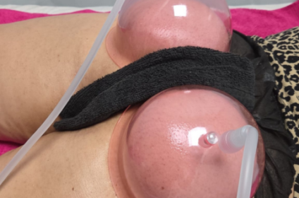 Procedimiento de levantamiento de glúteos no invasivo en Ponce, Puerto Rico.