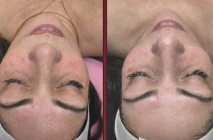 Sesión de limpieza facial profunda para eliminar impurezas en Ponce.