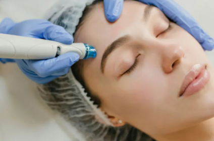 Tratamiento de microagujas microneedling en Bella Esthetic by Mayté Pérez, San Juan Puerto Rico