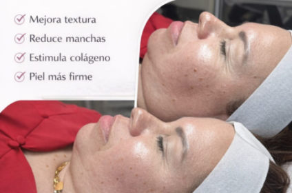 Tratamiento de Microneedling para mejorar la textura de la piel en Mini Esthetik Ponce.