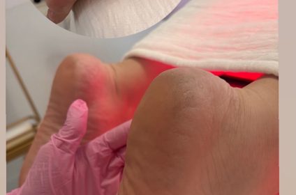 Tratamiento Elixir Reparador de Talones con fototerapia de luz LED en NO FILTER Skin & Beauty Gurabo PR.