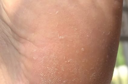 Evaluación inicial de piel seca y durezas en talones antes del tratamiento de Pedicure Spa en Karla’s Beauty Salon Rincón PR.